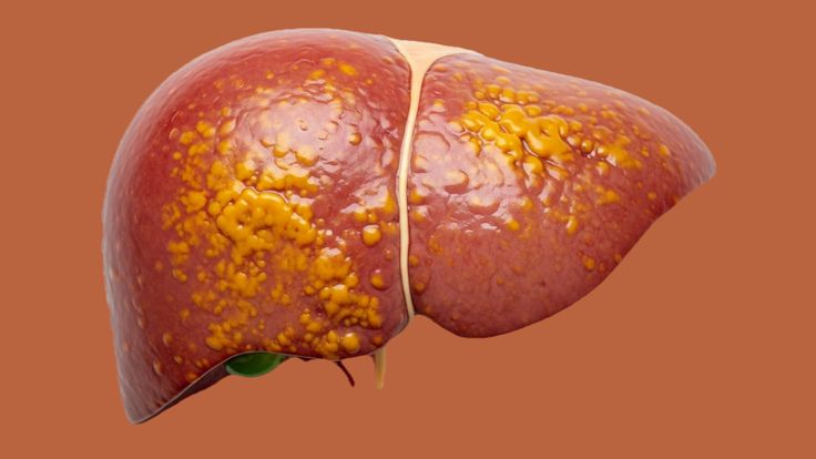 THE HEALTHY GOANUnderstanding fatty liver disease: A modern epidemic